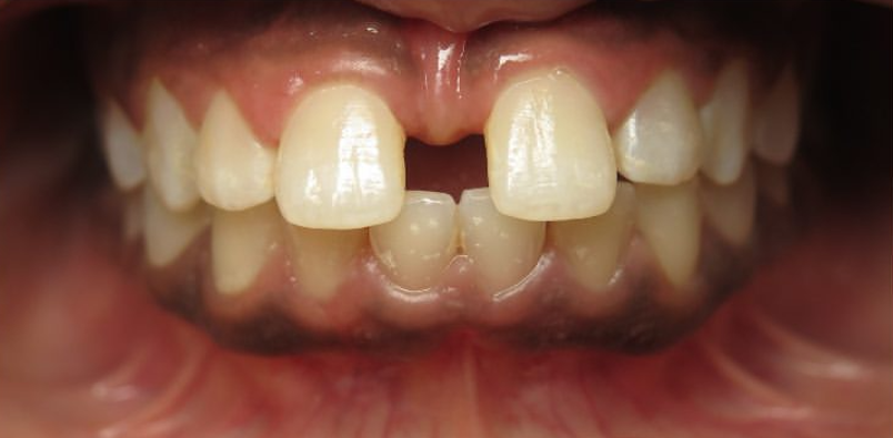 Espacement dentaire avant traitement par aligneurs AlignSmile